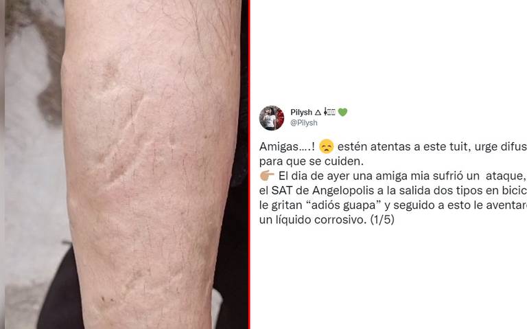 Hombres le arrojan ácido a una mujer en zona Angelópolis