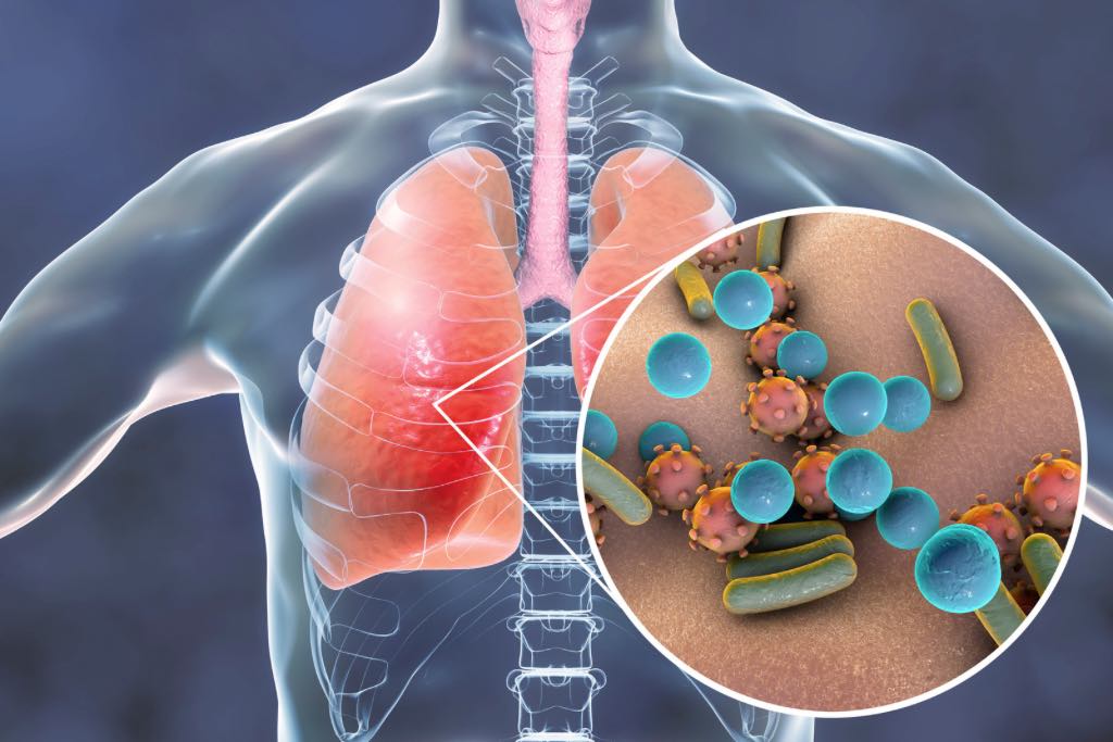 Temporada de influenza 2023: ¿Cuáles son los tipos de virus que propagan la enfermedad?