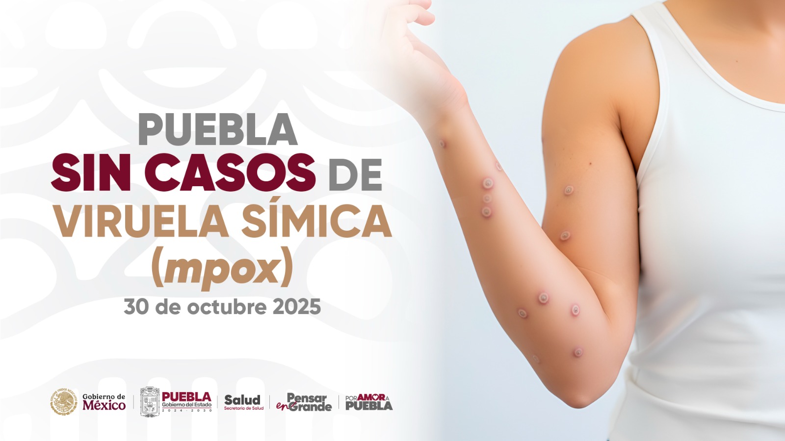 De la alarma a la calma: descartan viruela del mono en Puebla; los casos son coxsackie